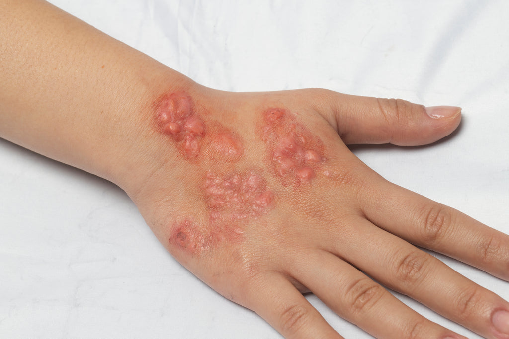 Bondo Moulds — Infected Skin Collection
