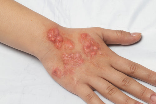 Bondo Moulds — Infected Skin Collection